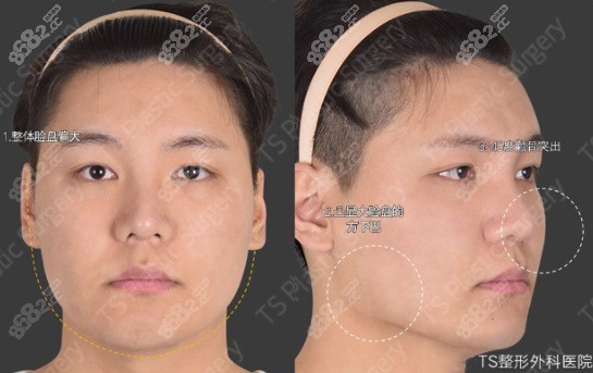 韩国TS男士面部轮廓手术前照片