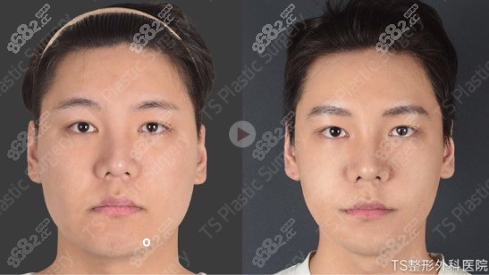 韩国TS男士面部轮廓手术前后对比
