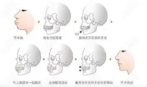 重庆王涛医生正颌手术示意图