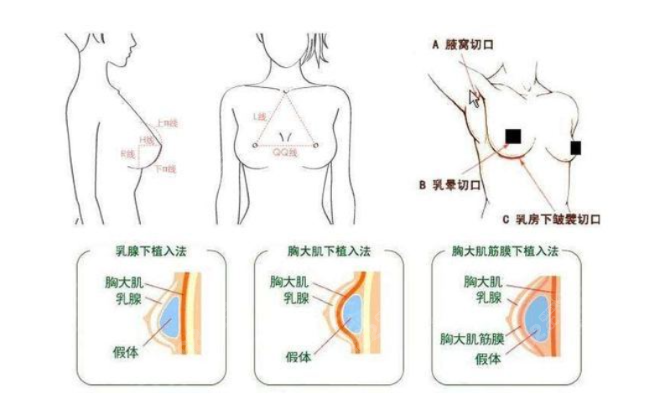 武汉亚韩胸部整形