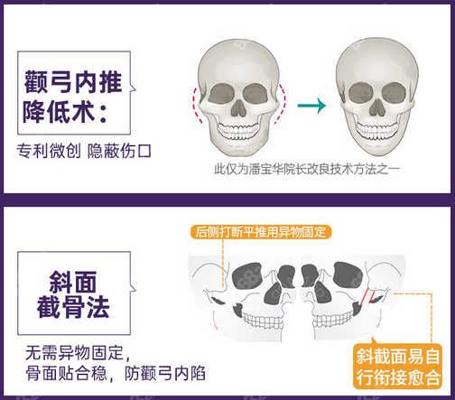 重庆华美微创颧弓颧骨降低技术