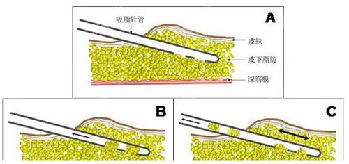 中山韩妃吸脂