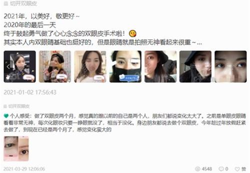 <!--<i data=20240705-sp></i>-->做雙眼皮術(shù)后反饋