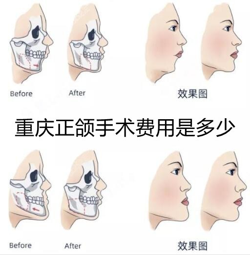 重庆做正颌手术的费用