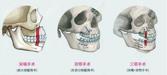 正颌手术三种类型