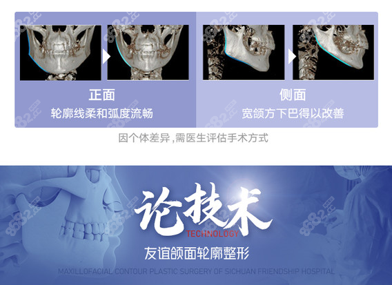 成都磨骨手术费用