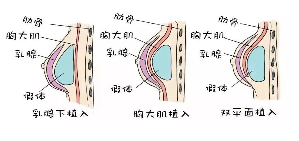 重庆美仑美奂董开云隆胸