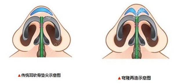 传统隆鼻和穹隆再造技术对比图