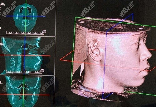 杨磊博士复杂正畸病例采用invivo5软件做数字化三维重叠