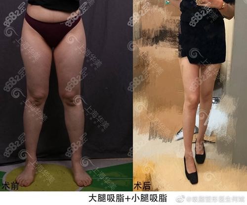 上海华美何斌大腿吸脂