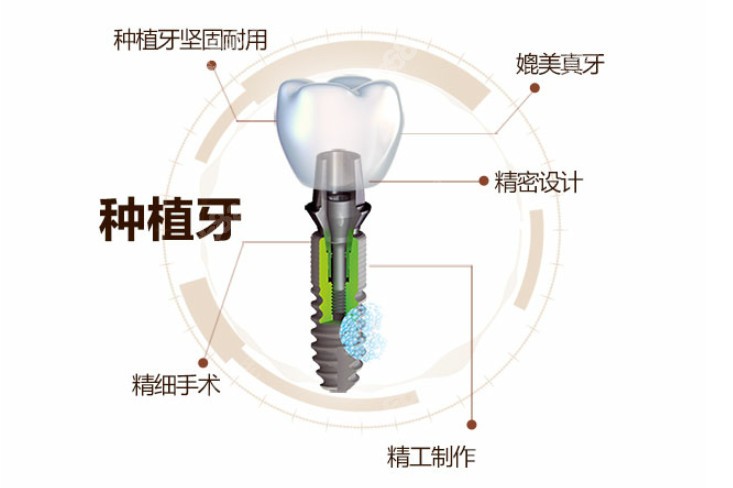 牙齿缺失做种植牙的优势有哪些