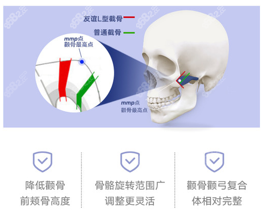 上海愉悦美联臣颧骨内推技术靠谱