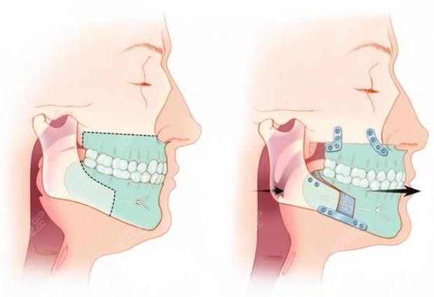 正颌手术的不同术式模拟图