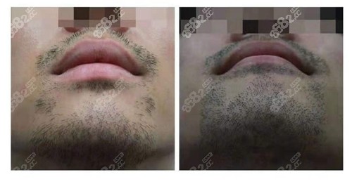 杭州薇琳胡须种植对比照