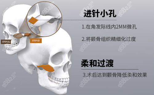 一针降颧骨手术方法