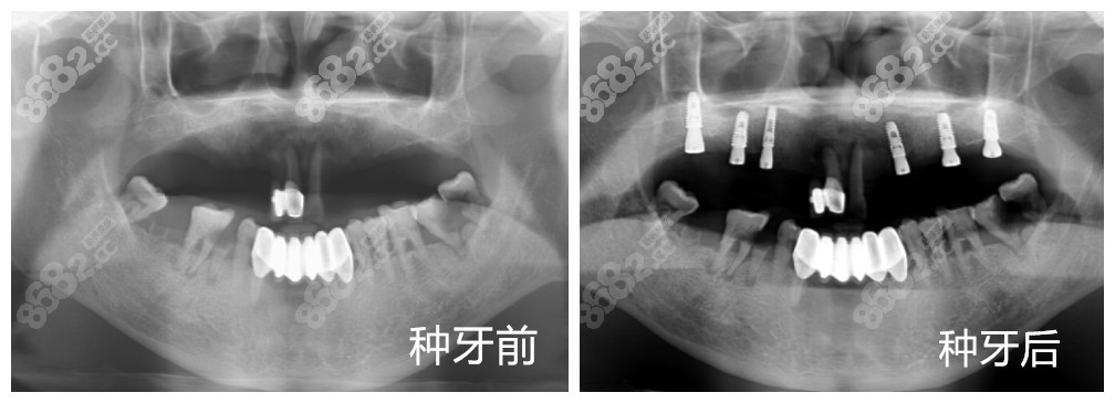 在<!--<i data=20240705-sp></i>-->口腔做种植牙顾客前后对比图