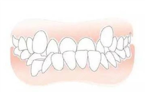 还在牙齿不齐而烦恼？