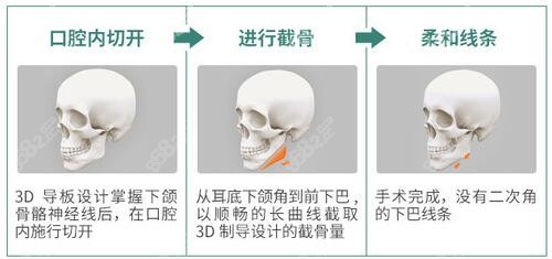 单磊医生磨骨优势