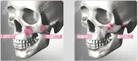 上海李志海磨骨技术怎么样