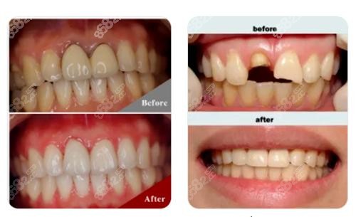 烤瓷牙修复前后对比图