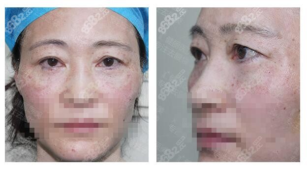 健麗醫(yī)美去眼袋術(shù)后