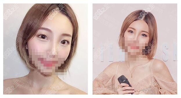 健麗醫(yī)美去眼袋術(shù)后一周