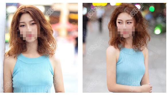 健麗醫(yī)美去眼袋術(shù)后