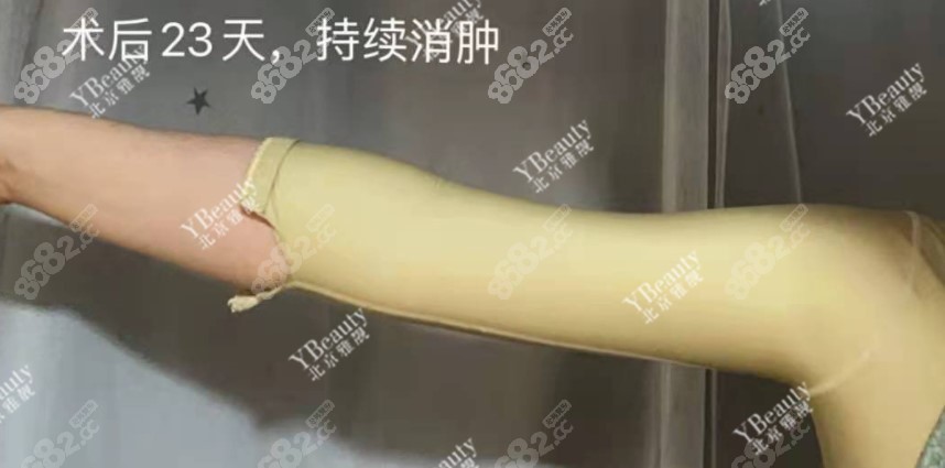 北京雅靓国海军手臂吸脂术后23天