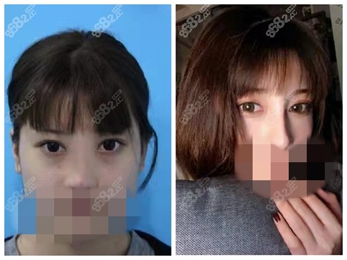 佛山美莱隆鼻前后对比照