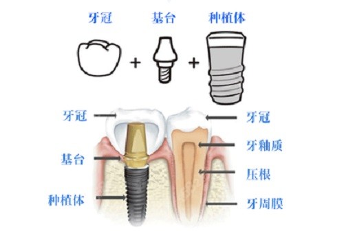 韩国登腾种植牙组成部分