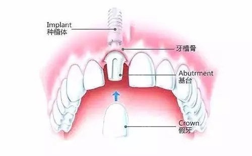种植牙包含的部位