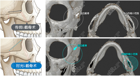 上海时光颧骨整形示意图