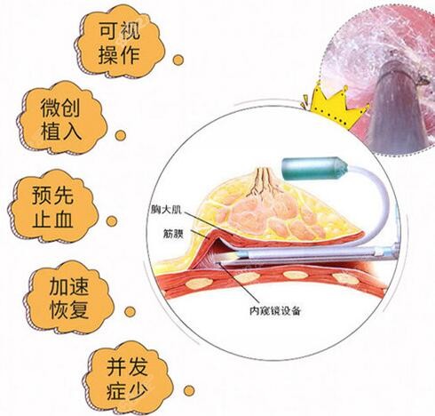 福州格莱美做假体隆胸优势