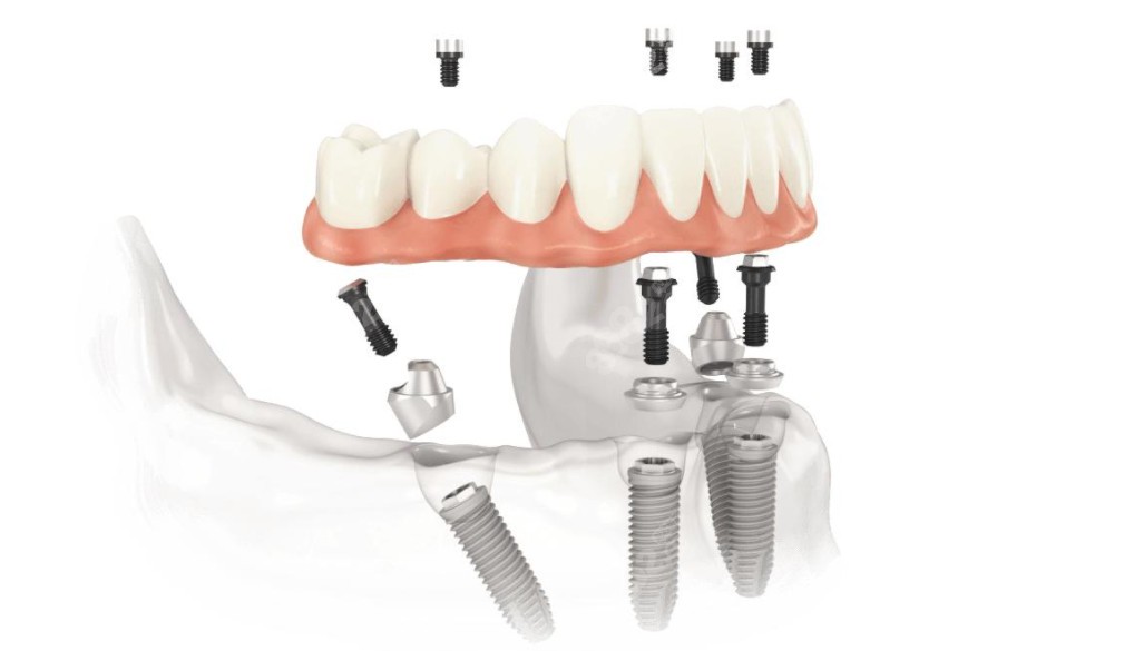 all-on-4半口种植牙示意图