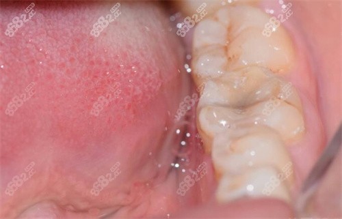 长沙优仕口腔补牙之后 长沙优仕口腔补牙之后