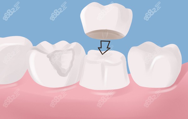 深圳根管治疗后牙冠的价格