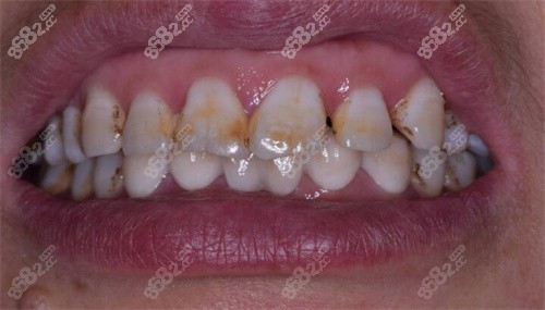 长沙优仕口腔烤瓷牙 长沙优仕口腔烤瓷牙