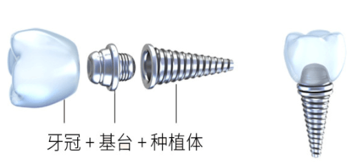 深圳格伦菲尔口腔清湖店种植牙示意图