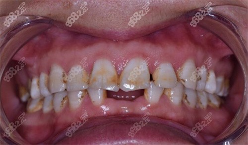 长沙优仕口腔牙缺失 长沙优仕口腔牙缺失