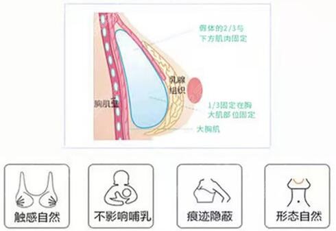 福州格莱美假体隆胸假体植入放置优势