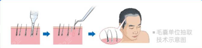 莱森植发技术说明