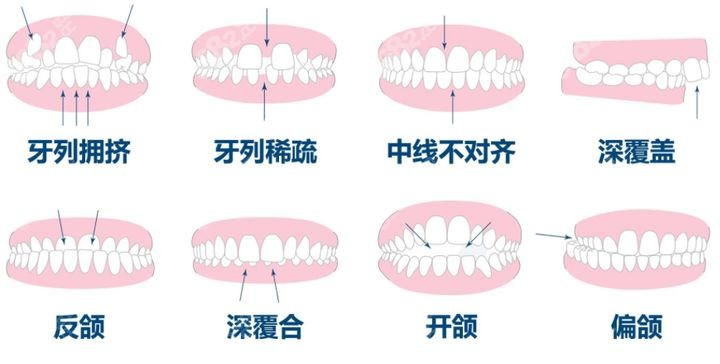 曾亮医生可做各类不同错颌畸形矫正