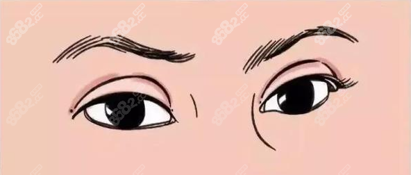 上海唐毅双眼皮失败修复