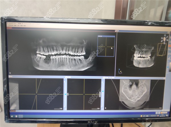 计算机辅助种植牙数据更精准