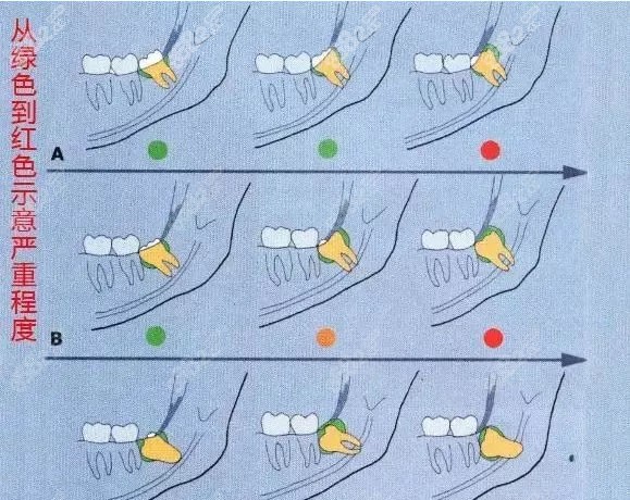 智齿阻生分类示意图图片