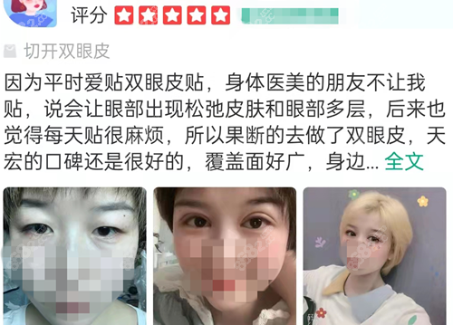 山东德州天宏医疗美容割双眼皮怎么样