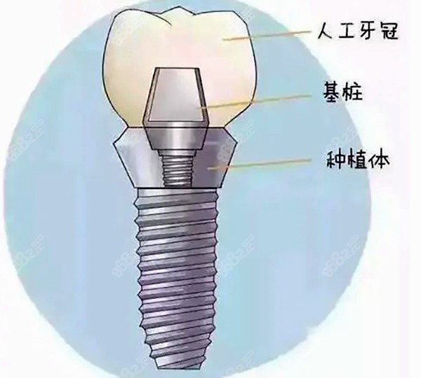 互齿家种植牙的收费