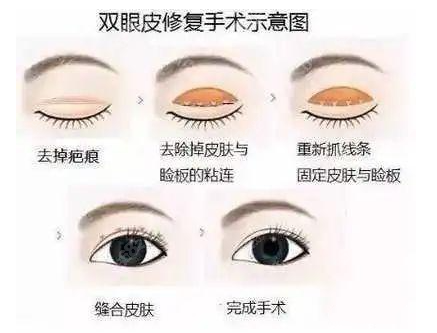 上海唐毅双眼皮失败修复示意图