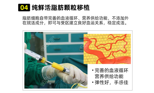 合肥华美整形医院手术过程第四步是纯鲜活脂肪颗粒移植