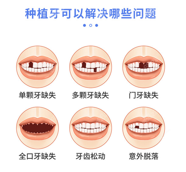 罗缘口腔种植牙多少钱